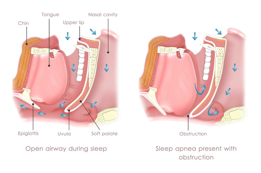 A-diagram-illustrating-Obstructive-Sleep-Apnea-(OSA)-before-sleep-apnea-surgery
