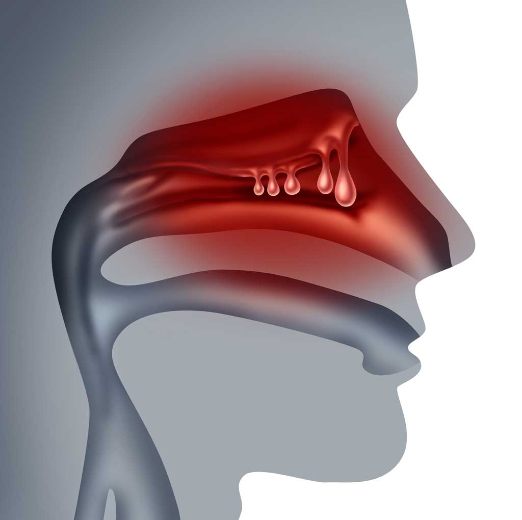 Digital-illustration-of-nasal-polyps