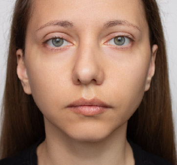 Nasal Septum Deviation