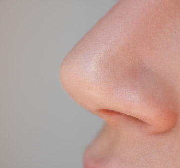 Nasal Turbinate Hypertrophy