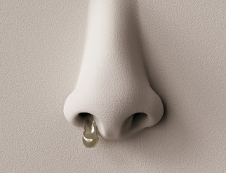 Thick, discolored discharge from the nose