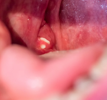 Tonsil Stone
