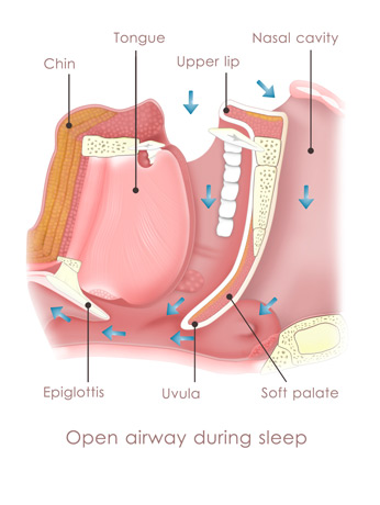 A-diagram-illustrating-Obstructive-Sleep-Apnea-(OSA)-before-sleep-apnea-surgery A-diagram-illustrating-Obstructive-Sleep-Apnea-(OSA)-before-sleep-apnea-surgery