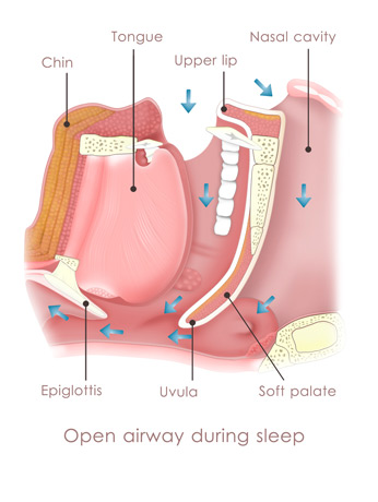 A-diagram-illustrating-Obstructive-Sleep-Apnea-(OSA) A-diagram-illustrating-Obstructive-Sleep-Apnea-(OSA)