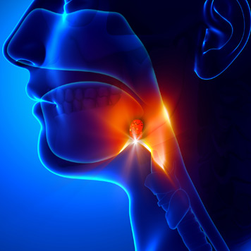 Digital-illustration-of-the-tonsils-before-Beverly-Hills-tonsil-surgery Digital-illustration-of-the-tonsils-before-Beverly-Hills-tonsil-surgery