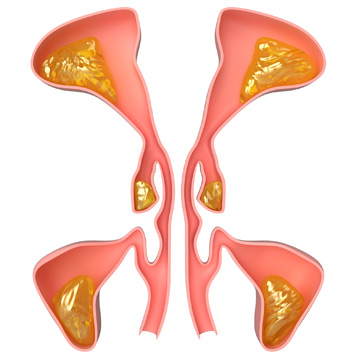 Illustration-of-nasal-sinus-with-sinusitis-that-needs-balloon-sinuplasty Illustration-of-nasal-sinus-with-sinusitis-that-needs-balloon-sinuplasty