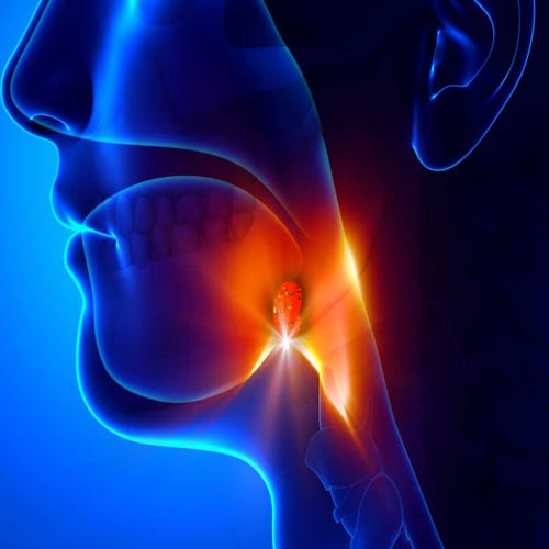 Tonsillectomy
